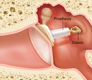 Cross section of ear showing outer, inner, and middle ear structures with prosthesis replacing incus.