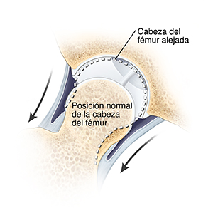 Corte transversal de la articulación de la cadera en el que se ve que están sacando la cabeza del fémur de la cavidad. La línea punteada muestra la posición normal de la cabeza del fémur en la cavidad.