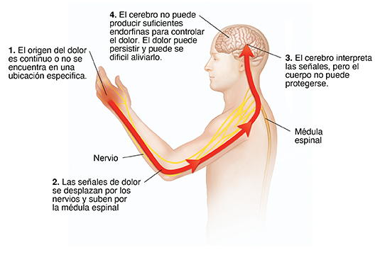 Contorno de una persona con un brazo en alto, que muestra el ciclo del dolor. El origen del dolor es continuo o no se encuentra en una ubicación especifica. Las señales de dolor se desplazan por los nervios y suben por la médula espinal. El cerebro interpreta las señales, pero el cuerpo no puede protegerse. 4 El cerebro no puede producir suficientes endorfinas para controlar el dolor. El dolor puede persistir y puede se dificil aliviarlo.