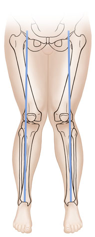 Vista frontal de las piernas de un niño donde se observan los huesos con las piernas en X.