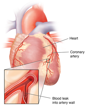 Front view of the heart with a blow-up view showing a coronary artery dissection.