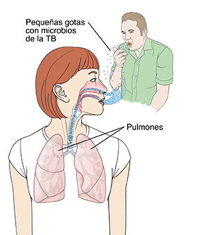 Contorno de la cabeza y el pecho de una mujer con la cabeza girada hacia un lado. Puede verse el interior de la nariz, las vías respiratorias y los pulmones. Imagen de fondo de un hombre liberando gotas con gérmenes de TB al toser. La mujer inhala las pequeñas gotas con el virus que ingresan por la nariz a los pulmones.